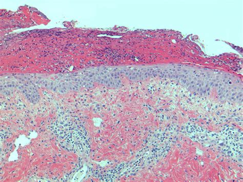 Octreotide Responsive Necrolytic Migratory Erythema In A Patient With