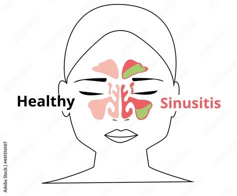 Sinusitis medical treatment. Nasal sinus. Healthy and inflammation ...