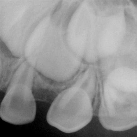 Periapical radiograph of the lesion (a) Pre-operation; (b) 2 years... | Download Scientific Diagram