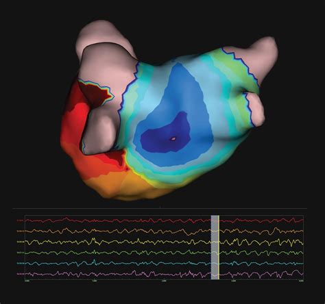 Fibrillazione Atriale Al Monzino Una Nuova Tecnica Tecnica Ospedaliera