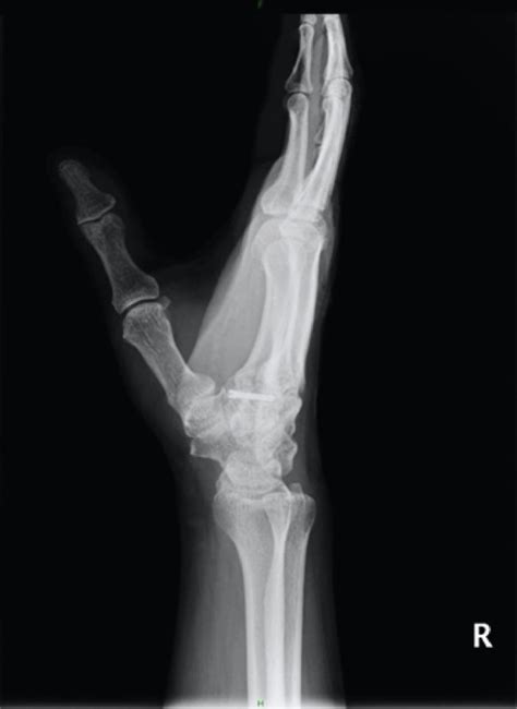 Radiograph Years After The Surgery A Posteroanterior View B