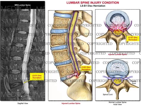 Lumbar Disc Herniation L5 S1