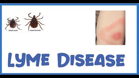 Lyme Disease Symptoms 3 Stages Of Lyme Disease Diagnosis And