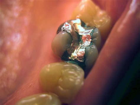 Amalgam Fillings: Are They Safe? Risks & Alternatives - Mouth Ninja