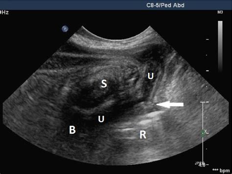 Figure From Usefulness Of Transperineal Ultrasonography Tpus In