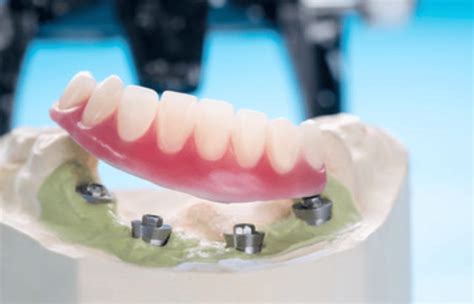 How Implant Supported Dentures Helps To Restore Smile