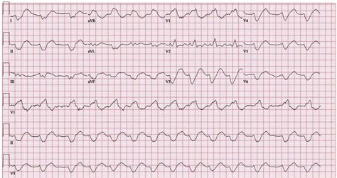 Sine Wave Electrocardiogram Rhythm In A Patient On Haemodialysis