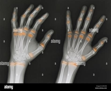 hand x-ray 12 year old male, two views with the epiphyseal growth ...