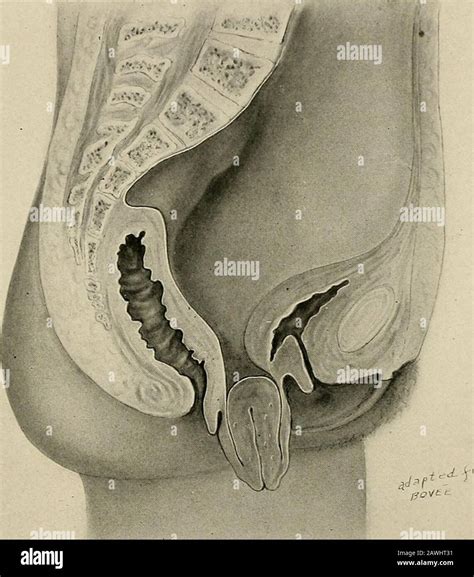 Hernia repair hi-res stock photography and images - Alamy