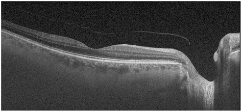 Detecting Structural Changes In The Choroidal Layer Of The Eye In