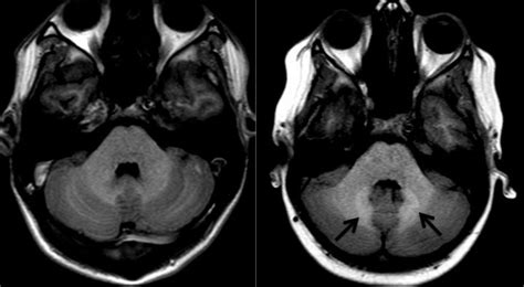 Gadolinium Deposition In The Brain Not Dose D Eurekalert