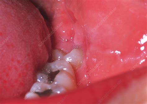 Signs And Symptoms Of Tooth Eruption In Babies Get More Anythink S