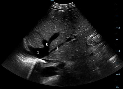 Patent Ductus Venosus And Congenital Heart Disease A Case Report And