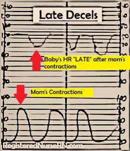 Early, Variable, and Late Decelerations