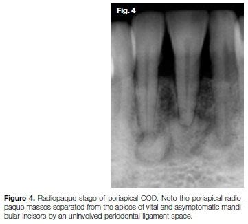 Periapical Cemental Dysplasia Stages