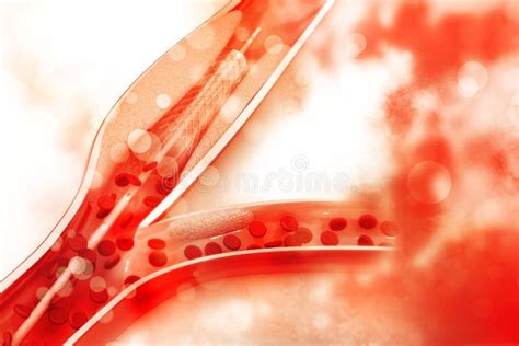 Procedimiento De Angioplastia Con Stent En Vena Stock De Ilustraci N