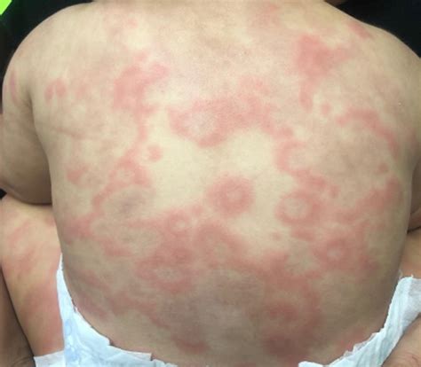 Urticaria Multiforme The Journal Of Pediatrics