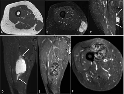 Soft Tissue Masses With Myxoid Stroma Can Conventional Magnetic