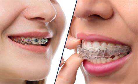 Cost Of Invisalign in Canada - Prairie Pines Dental Centre