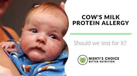 COW S MILK PROTEIN ALLERGY Should We Test For It YouTube