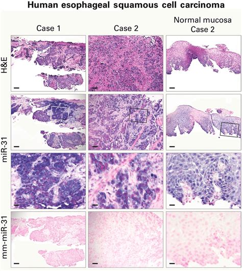 Localization Of MiR 31 In Human Esophageal Squamous Cell Carcinoma