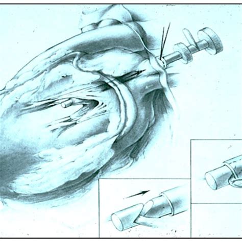 The Experimental Model Created To Map And Treat Atrial Fibrillation In Download Scientific