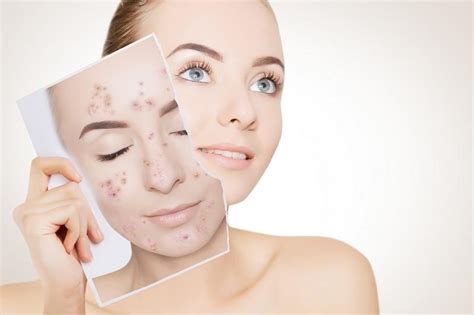 Come Eliminare Le Cicatrici Da Acne E Brufoli Cure E Rimedi Naturali