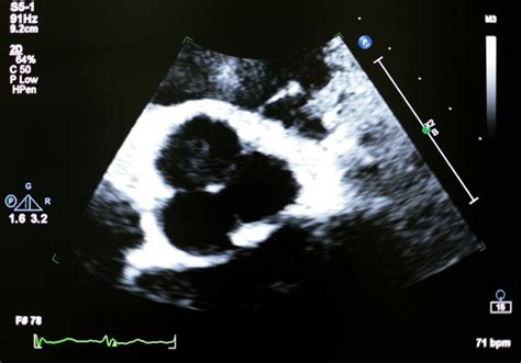 Calcified Aortic Valve Over 7 Royalty Free Licensable Stock Photos