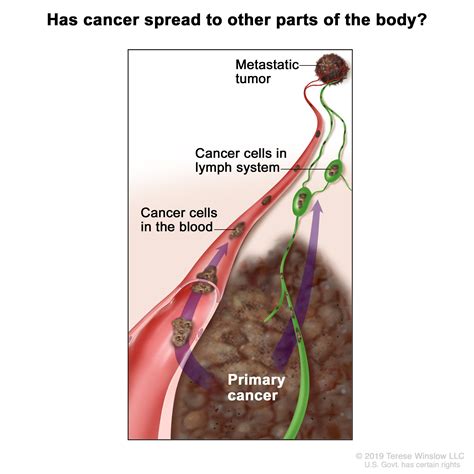 Melanoma Treatment Pdq® Patient Version Siteman Cancer Center