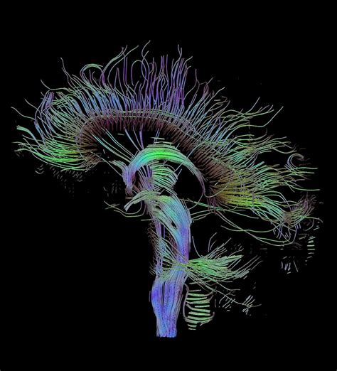 Diffusion MRI - wikidoc