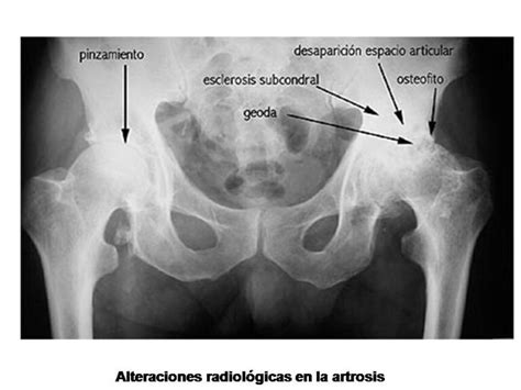 Descubre los Signos Radiológicos de la Artrosis Cervical Guía Completa