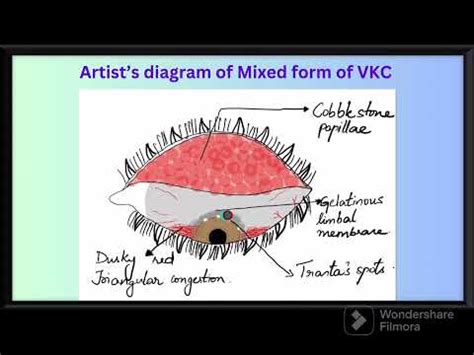 Vernal Kerato Conjunctivitis Vkc Spring Catarrh Warm Weather