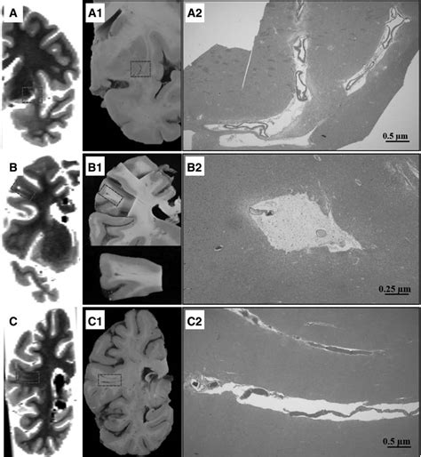 Stroke Aha Asa On Twitter Neuropathologic And Cognitive Correlates Of