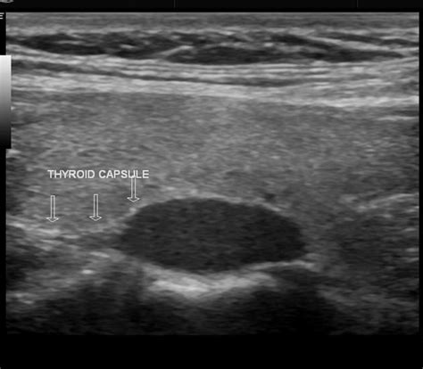 Parathyroid Ultrasound Anatomy