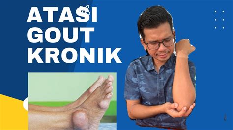 Bagaimana Nak Atasi Masalah Gout Yang Kronik Suplimengout Youtube