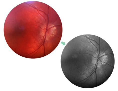 Optometry Atlas Optic Nerve Conditions Viewpoint