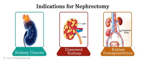 Nephrectomy - Types, Risks & Complications