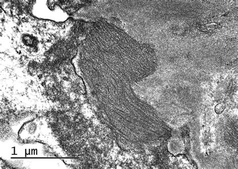 diagnostic approach  glomerulonephritis  fibrillar igg deposits
