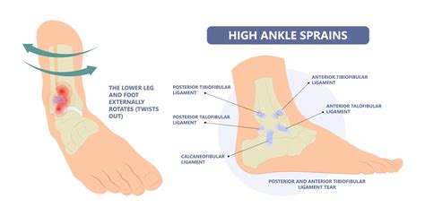 What Is A High Ankle Sprain Zamst Blog