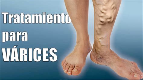 Varices Y Piernas Nuevos Consejos Para Mejorar La Off