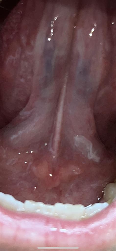 Is this Thrush? Peeling under the tongue, no pain. : r/medical