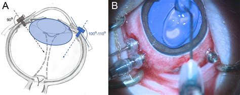 Subretinal Implantation Of RPE On A Carrier In Minipigs Guidelines For