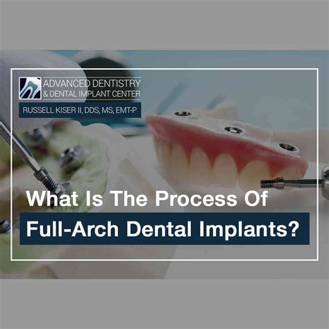 What Is The Process Of Full-Arch Dental Implants?