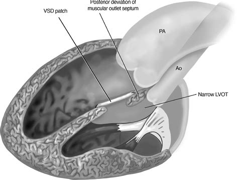 Yasui Conversion After Biventricular Repair In Patients With Left