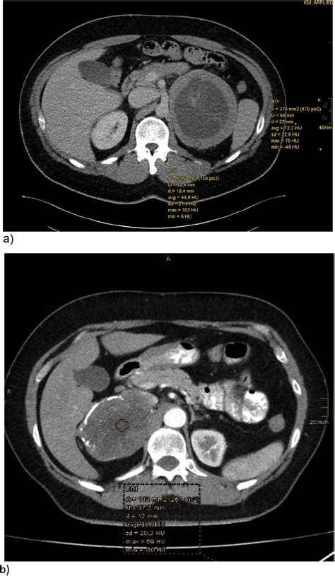 Two Giant Retroperitoneal Schwannomas Mimicking Adrenal Malignancy A