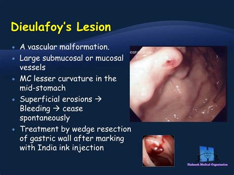 Ppt Gastrointestinal Bleeding Powerpoint Presentation Free Download Id 2005919