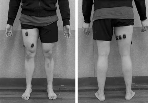 Positioning Of Electromyography Electrode Of Rectus Femoris Rf