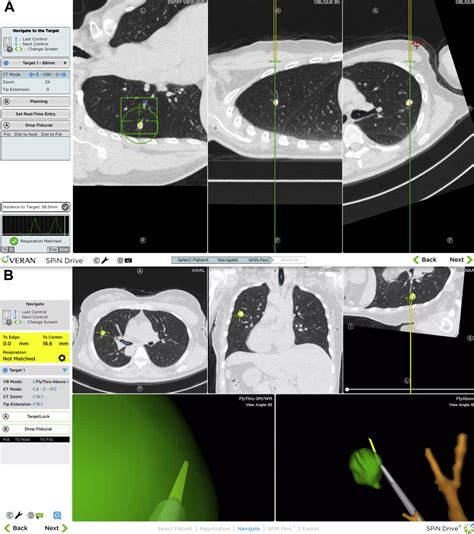 Electromagnetic Navigation Guided Preoperative Localization Of Small