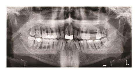 A Intraoral View Of The Patient After Extraction Of Teeth With Severe