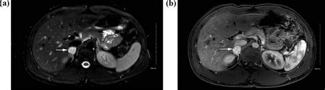 Adrenal Pheochromocytoma Axial Fat Saturated T2 Weighted Mri A And Download Scientific